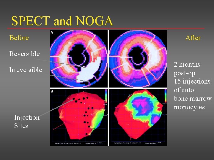 SPECT and NOGA Before After Reversible Irreversible Injection Sites 2 months post-op 15 injections