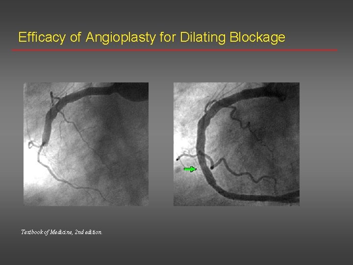 Efficacy of Angioplasty for Dilating Blockage Textbook of Medicine, 2 nd edition. 