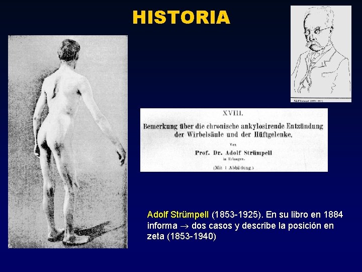 HISTORIA Adolf Strümpell (1853 -1925). En su libro en 1884 informa dos casos y HISTORIA Adolf Strümpell (1853 -1925). En su libro en 1884 informa dos casos y