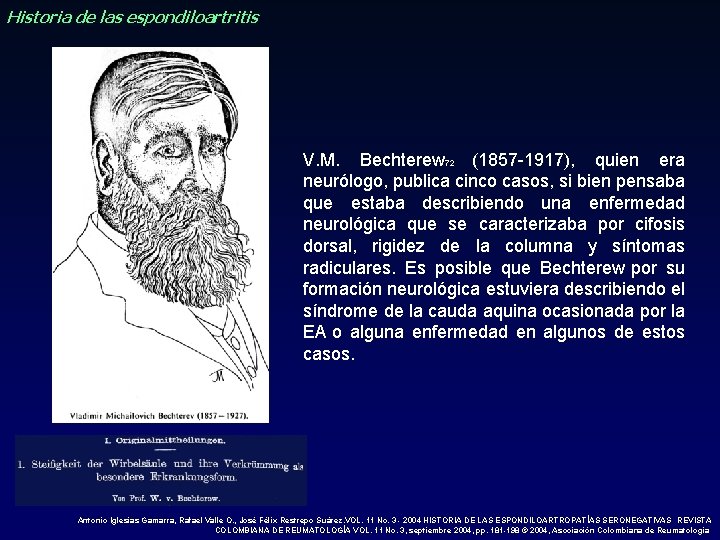 Historia de las espondiloartritis V. M. Bechterew 72 (1857 -1917), quien era neurólogo, publica Historia de las espondiloartritis V. M. Bechterew 72 (1857 -1917), quien era neurólogo, publica