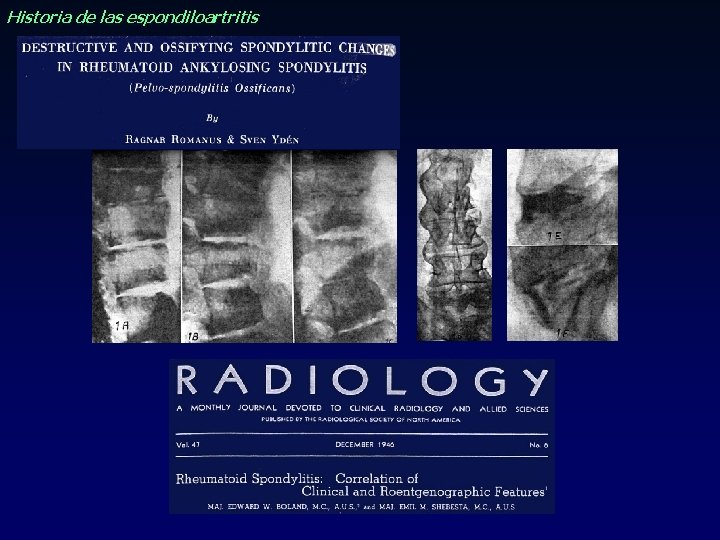 Historia de las espondiloartritis Historia de las espondiloartritis