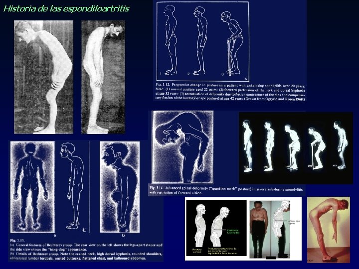 Historia de las espondiloartritis Historia de las espondiloartritis