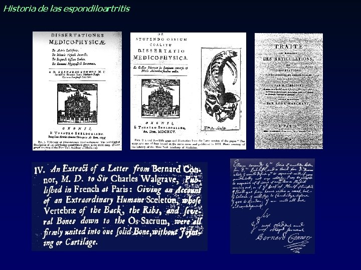 Historia de las espondiloartritis Historia de las espondiloartritis