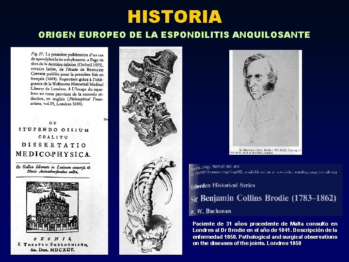 HISTORIA ORIGEN EUROPEO DE LA ESPONDILITIS ANQUILOSANTE Paciente de 31 años procedente de Malta HISTORIA ORIGEN EUROPEO DE LA ESPONDILITIS ANQUILOSANTE Paciente de 31 años procedente de Malta