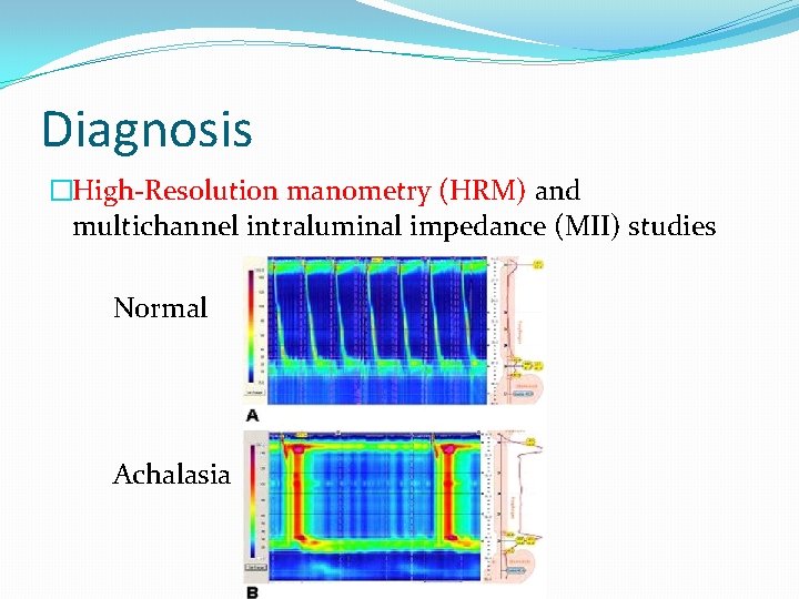 Diagnosis �High-Resolution manometry (HRM) and multichannel intraluminal impedance (MII) studies Normal Achalasia 