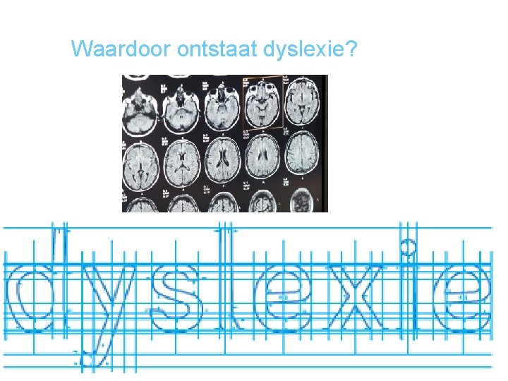 Waardoor ontstaat dyslexie? 