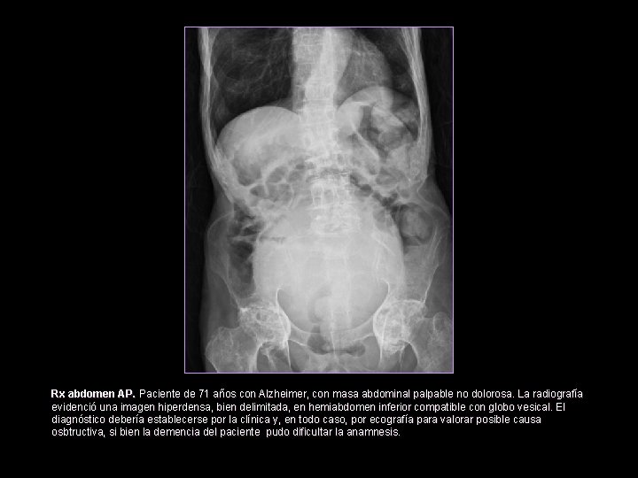 Rx abdomen AP. Paciente de 71 años con Alzheimer, con masa abdominal palpable no