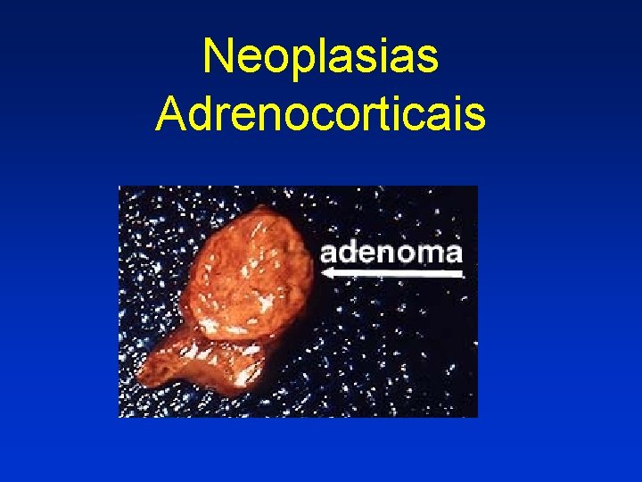 Neoplasias Adrenocorticais 