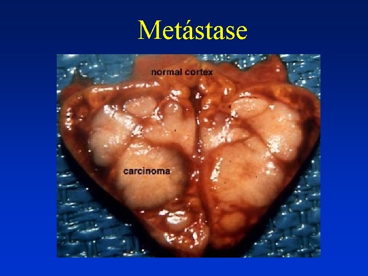 Metástase 