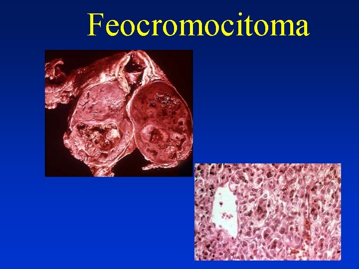 Feocromocitoma 