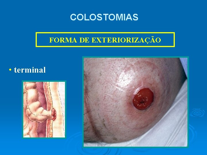 COLOSTOMIAS FORMA DE EXTERIORIZAÇÃO • terminal 