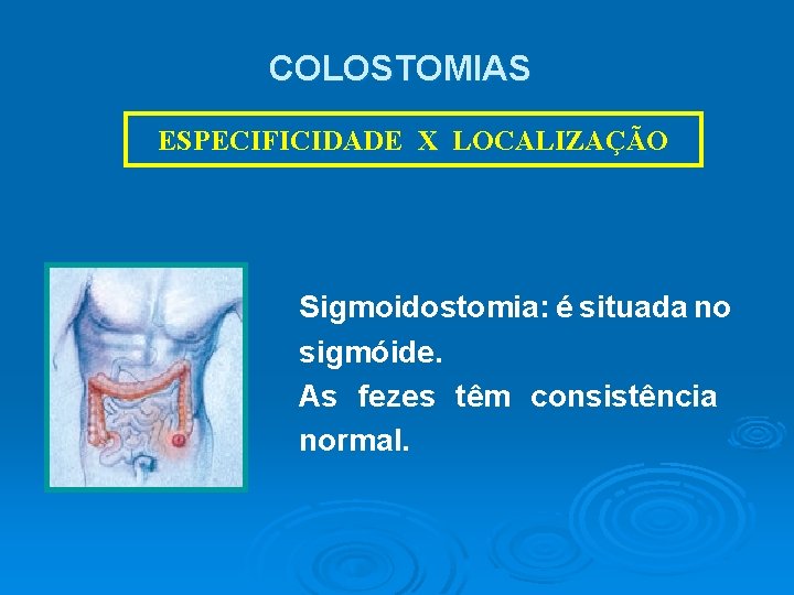 COLOSTOMIAS ESPECIFICIDADE X LOCALIZAÇÃO Sigmoidostomia: é situada no sigmóide. As fezes têm consistência normal.