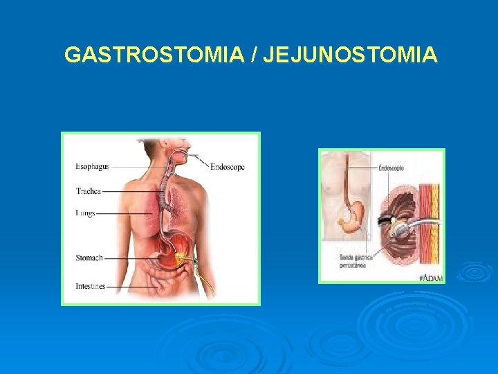 GASTROSTOMIA / JEJUNOSTOMIA 