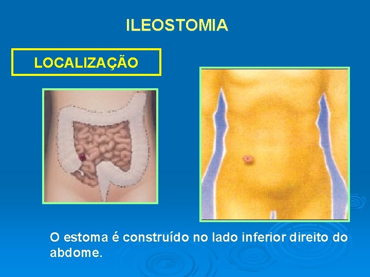 ILEOSTOMIA LOCALIZAÇÃO O estoma é construído no lado inferior direito do abdome. 