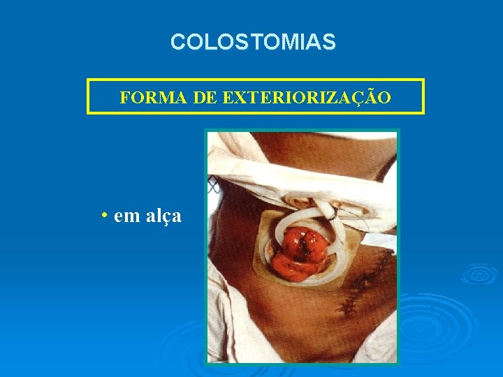 COLOSTOMIAS FORMA DE EXTERIORIZAÇÃO • em alça 