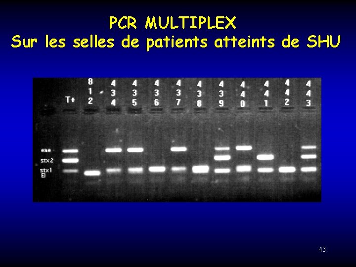 PCR MULTIPLEX Sur les selles de patients atteints de SHU 43 
