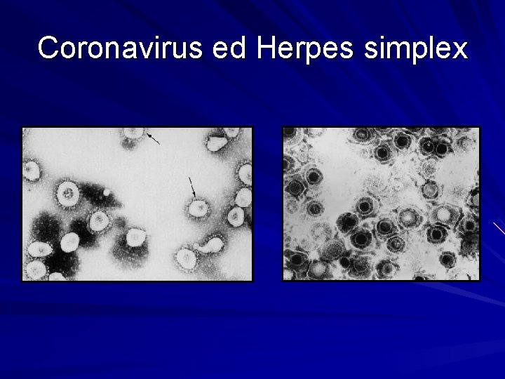 Coronavirus ed Herpes simplex 