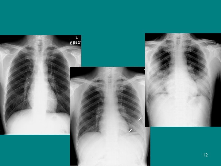 Chest Radiographs 12 