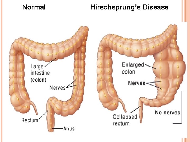 Normal Hirschsprung’s Disease 