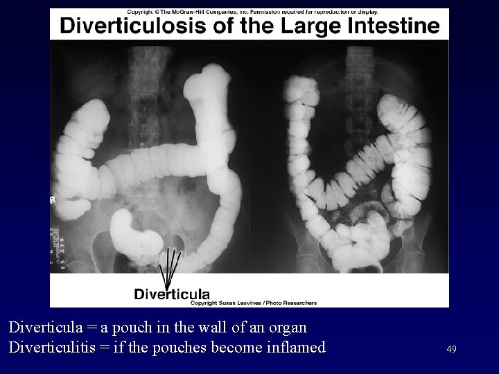 Diverticula = a pouch in the wall of an organ Diverticulitis = if the