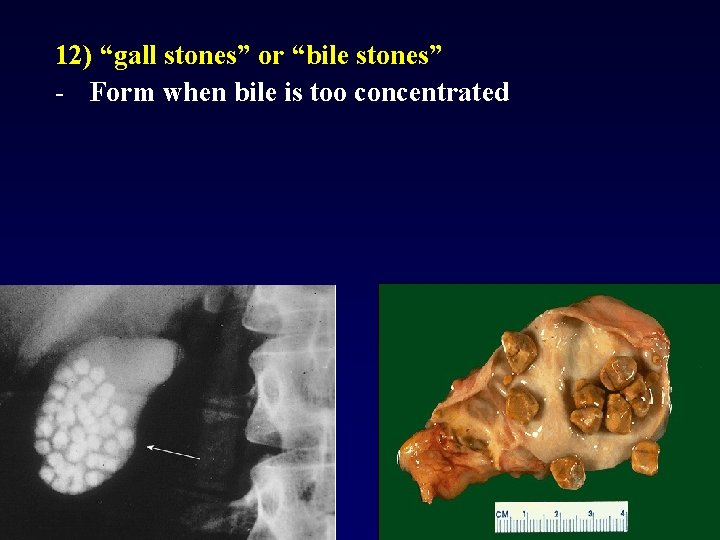 12) “gall stones” or “bile stones” - Form when bile is too concentrated 62