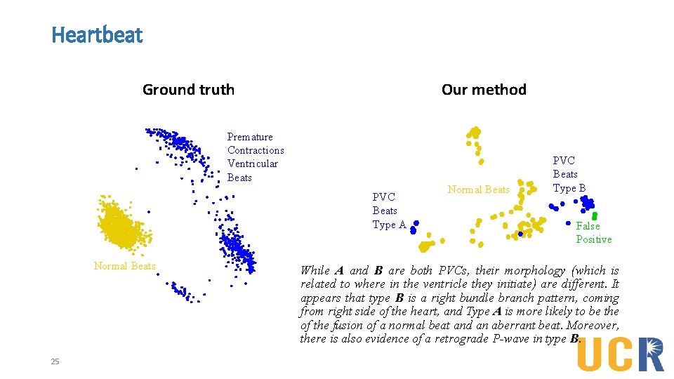 Heartbeat Ground truth Our method Premature Contractions Ventricular Beats PVC Beats Type A Normal