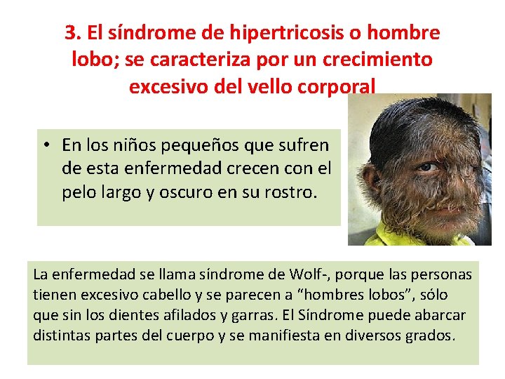 3. El síndrome de hipertricosis o hombre lobo; se caracteriza por un crecimiento excesivo