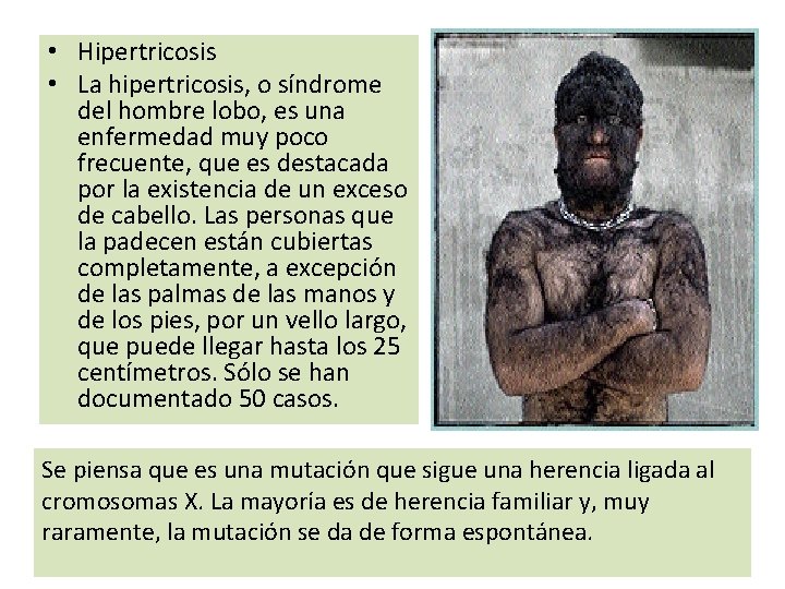  • Hipertricosis • La hipertricosis, o síndrome del hombre lobo, es una enfermedad