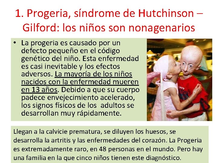 1. Progeria, síndrome de Hutchinson – Gilford: los niños son nonagenarios • La progeria