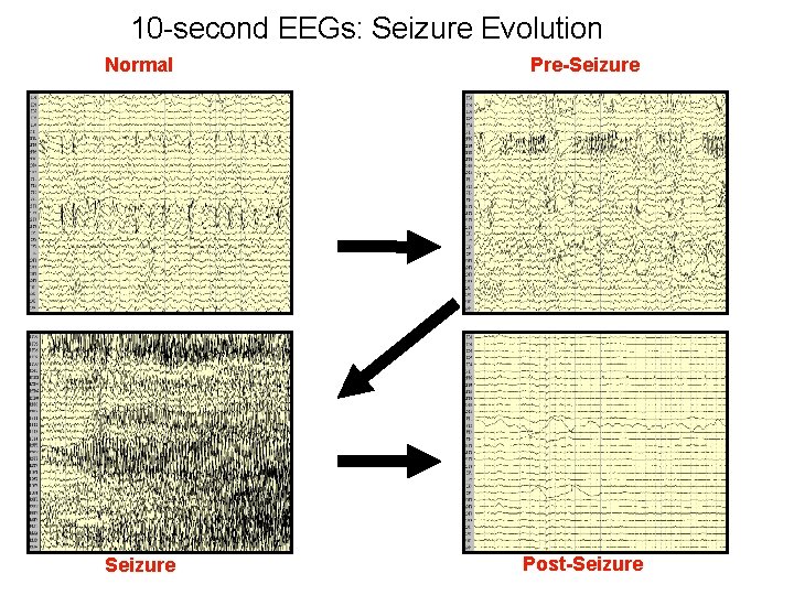 10 -second EEGs: Seizure Evolution Normal Pre-Seizure Post-Seizure 
