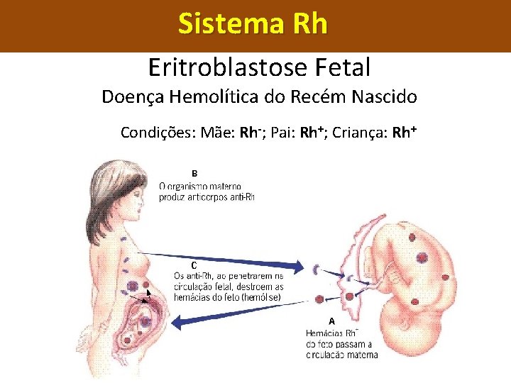 Sistema Rh Eritroblastose Fetal Doença Hemolítica do Recém Nascido Condições: Mãe: Rh-; Pai: Rh+;