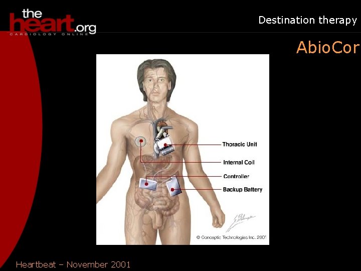 Destination therapy Abio. Cor Heartbeat – November 2001 