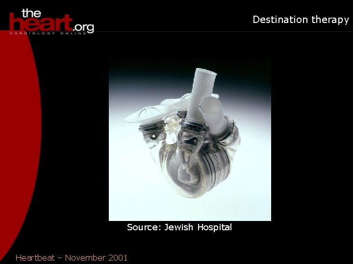 Destination therapy Source: Jewish Hospital Heartbeat – November 2001 