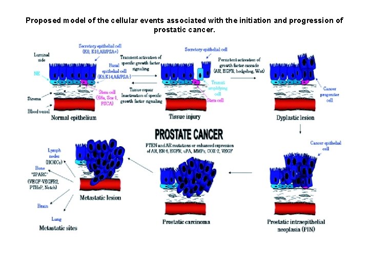 Proposed model of the cellular events associated with the initiation and progression of prostatic