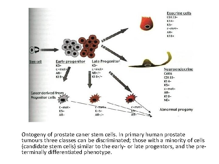 Ontogeny of prostate caner stem cells. In primary human prostate tumours three classes can