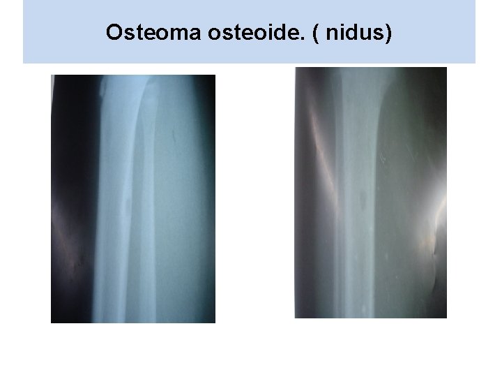 Osteoma osteoide. ( nidus) 