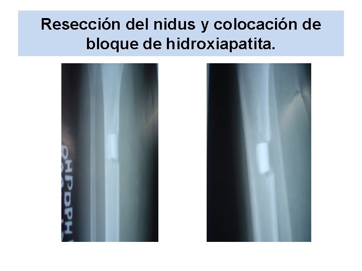 Resección del nidus y colocación de bloque de hidroxiapatita. 