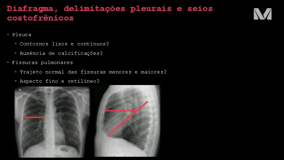 Diafragma, delimitações pleurais e seios costofrênicos • Pleura • Contornos lisos e contínuos? • Diafragma, delimitações pleurais e seios costofrênicos • Pleura • Contornos lisos e contínuos? •