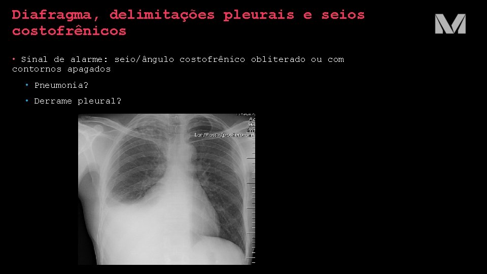 Diafragma, delimitações pleurais e seios costofrênicos • Sinal de alarme: seio/ângulo costofrênico obliterado ou Diafragma, delimitações pleurais e seios costofrênicos • Sinal de alarme: seio/ângulo costofrênico obliterado ou