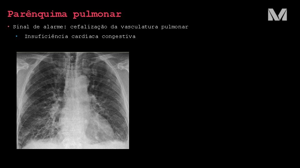 Parênquima pulmonar • Sinal de alarme: cefalização da vasculatura pulmonar • Insuficiência cardíaca congestiva Parênquima pulmonar • Sinal de alarme: cefalização da vasculatura pulmonar • Insuficiência cardíaca congestiva
