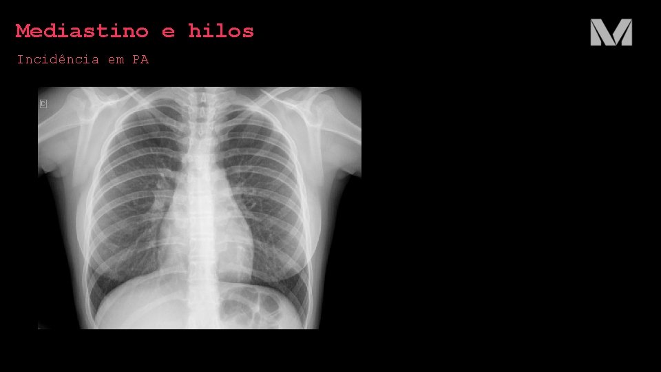 Mediastino e hilos Incidência em PA Mediastino e hilos Incidência em PA