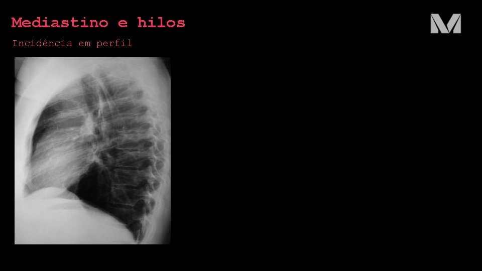 Mediastino e hilos Incidência em perfil Mediastino e hilos Incidência em perfil