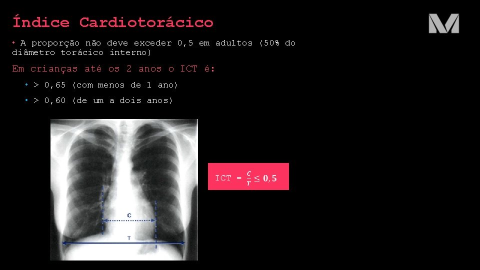 Índice Cardiotorácico • A proporção não deve exceder 0, 5 em adultos (50% do Índice Cardiotorácico • A proporção não deve exceder 0, 5 em adultos (50% do