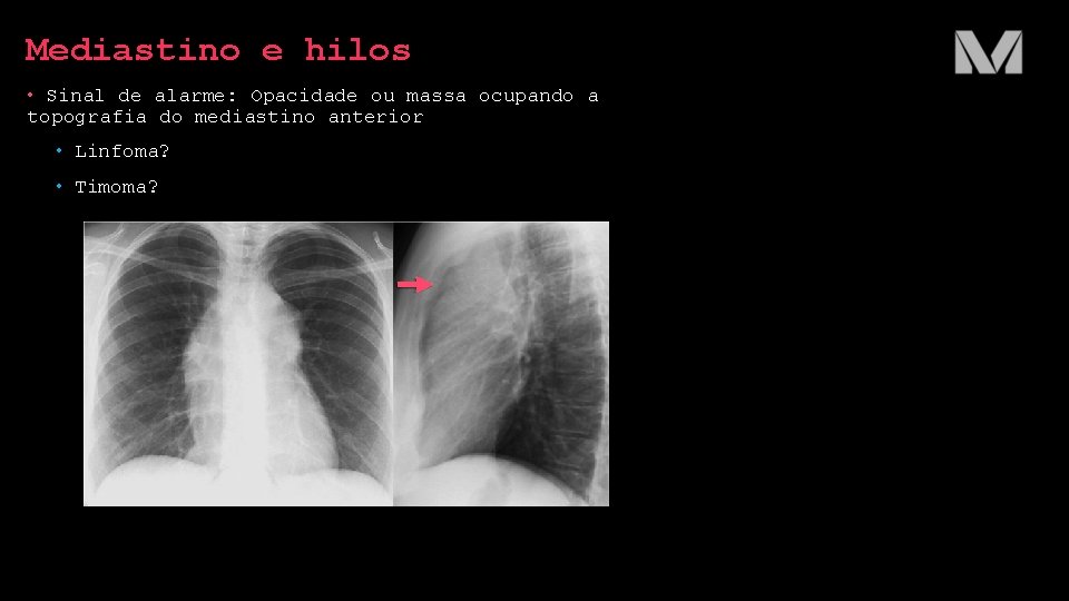 Mediastino e hilos • Sinal de alarme: Opacidade ou massa ocupando a topografia do Mediastino e hilos • Sinal de alarme: Opacidade ou massa ocupando a topografia do