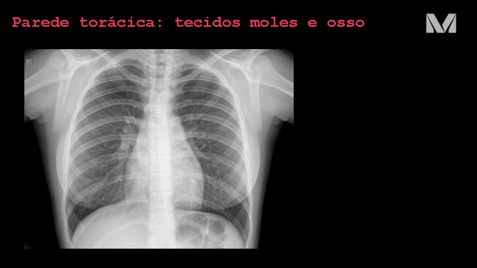 Parede torácica: tecidos moles e osso Parede torácica: tecidos moles e osso