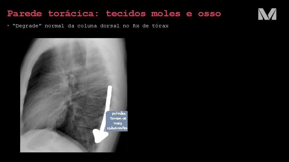 Parede torácica: tecidos moles e osso • “Degrade” normal da coluna dorsal no Rx Parede torácica: tecidos moles e osso • “Degrade” normal da coluna dorsal no Rx