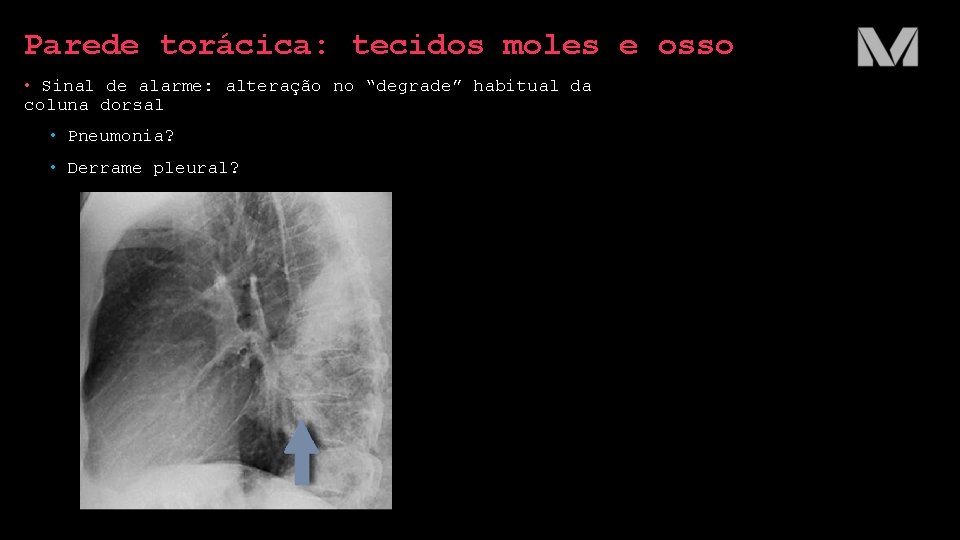 Parede torácica: tecidos moles e osso • Sinal de alarme: alteração no “degrade” habitual Parede torácica: tecidos moles e osso • Sinal de alarme: alteração no “degrade” habitual