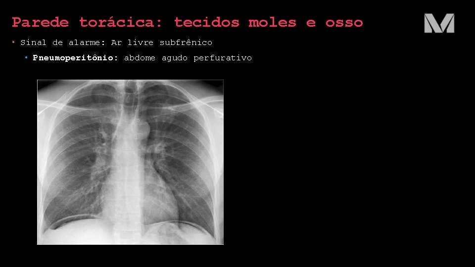 Parede torácica: tecidos moles e osso • Sinal de alarme: Ar livre subfrênico • Parede torácica: tecidos moles e osso • Sinal de alarme: Ar livre subfrênico •
