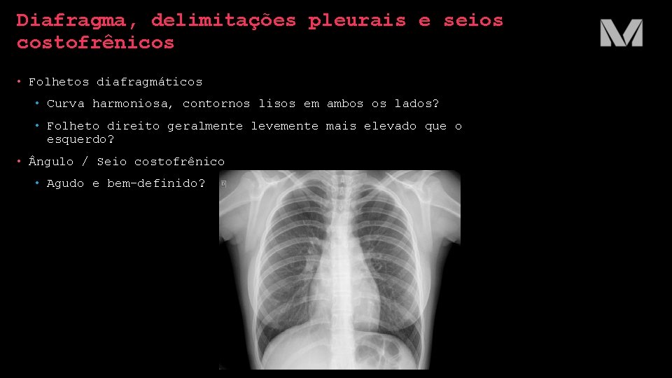 Diafragma, delimitações pleurais e seios costofrênicos • Folhetos diafragmáticos • Curva harmoniosa, contornos lisos Diafragma, delimitações pleurais e seios costofrênicos • Folhetos diafragmáticos • Curva harmoniosa, contornos lisos
