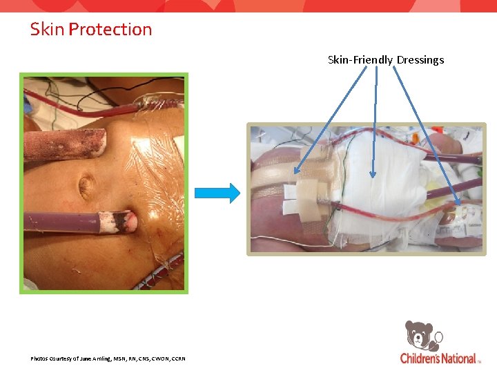 Skin Protection Skin-Friendly Dressings Photos Courtesy of June Amling, MSN, RN, CNS, CWON, CCRN